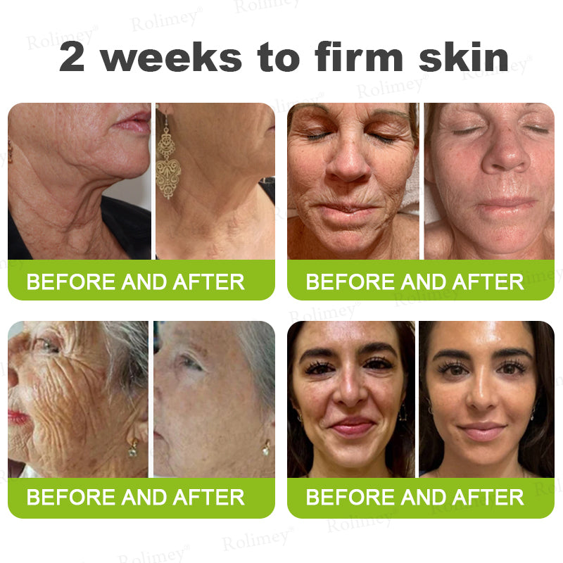 🍁👨‍⚕️Made and shipped from Canada 💫Rolimey® Botox & Vita-A Retinol Shot Wrinkle-Lift Tightening cream - Last Day Promotion 70% OFF