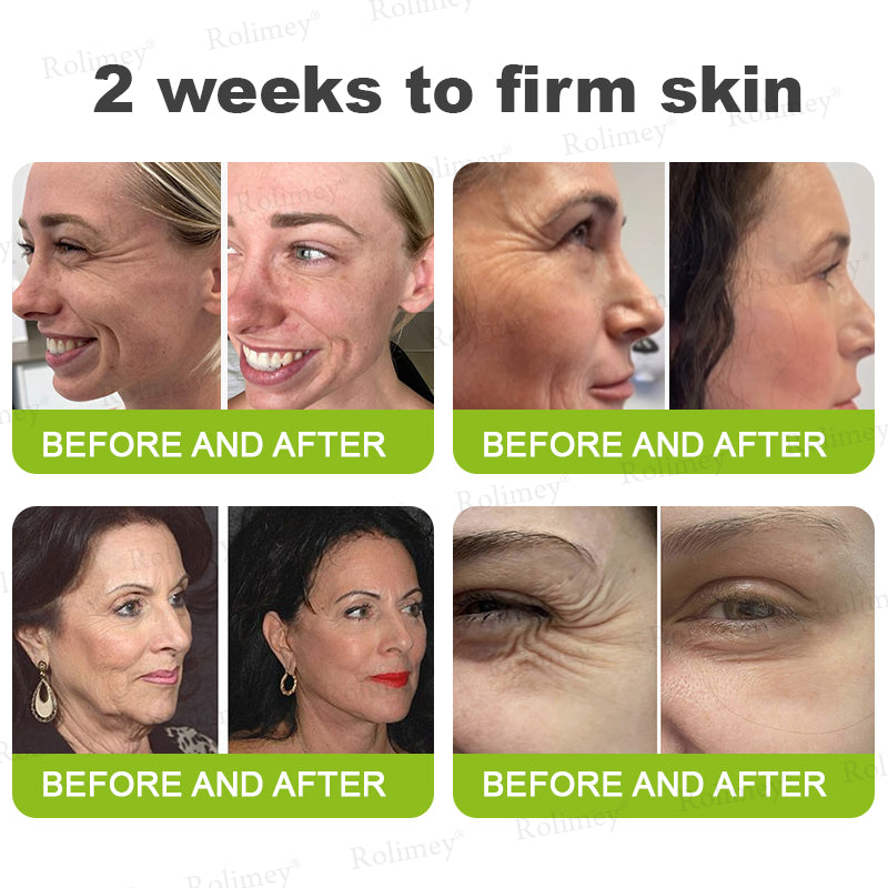 🍁👨‍⚕️Made and shipped from Canada 💫Rolimey® Botox & Vita-A Retinol Shot Wrinkle-Lift Tightening cream - Last Day Promotion 70% OFF