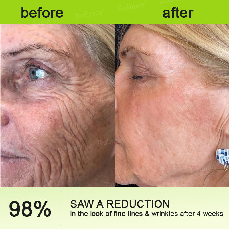 🍁👨‍⚕️Made and shipped from Canada 💫Rolimey® Botox & Vita-A Retinol Shot Wrinkle-Lift Tightening cream - Last Day Promotion 70% OFF