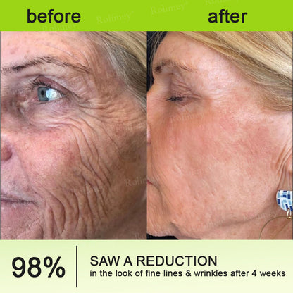 🍁👨‍⚕️Made and shipped from Canada 💫Rolimey® Botox & Vita-A Retinol Shot Wrinkle-Lift Tightening cream - Last Day Promotion 70% OFF
