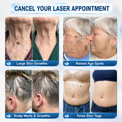🏆🇨🇦 Official Canada Store | Rolimey® 7-Day Skin Tag & Blemish Roll-On – Painless & Scar-Free