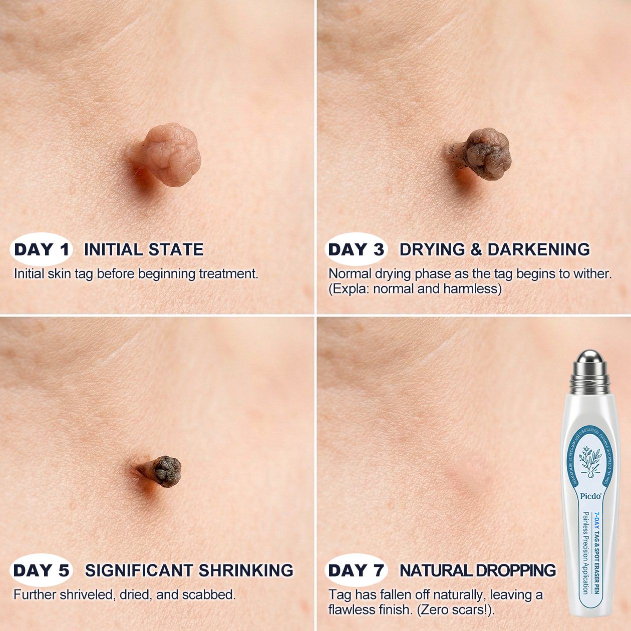 🏆🇨🇦 Official Canada Store | Rolimey® 7-Day Skin Tag & Blemish Roll-On – Painless & Scar-Free