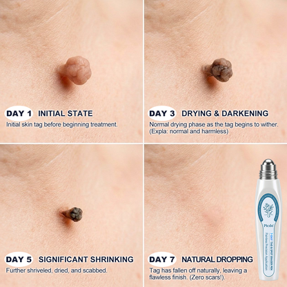 🏆🇨🇦 Official Canada Store | Rolimey® 7-Day Skin Tag & Blemish Roll-On – Painless & Scar-Free